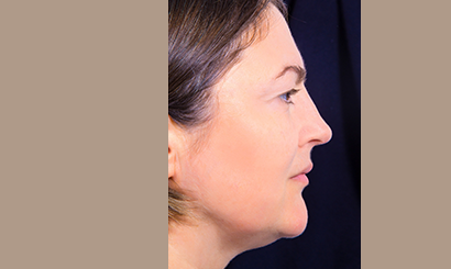 Cheek Augmentation_After