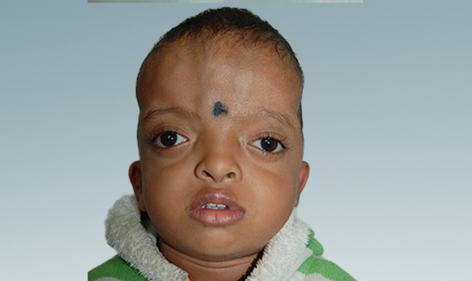 Craniosynostosis Surgery_Post op